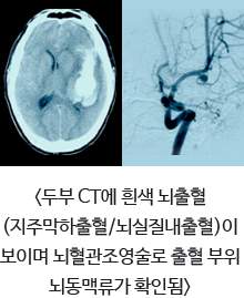 두부 CT에 흰색 뇌출혈(지주막하출혈/뇌실질내출혈)