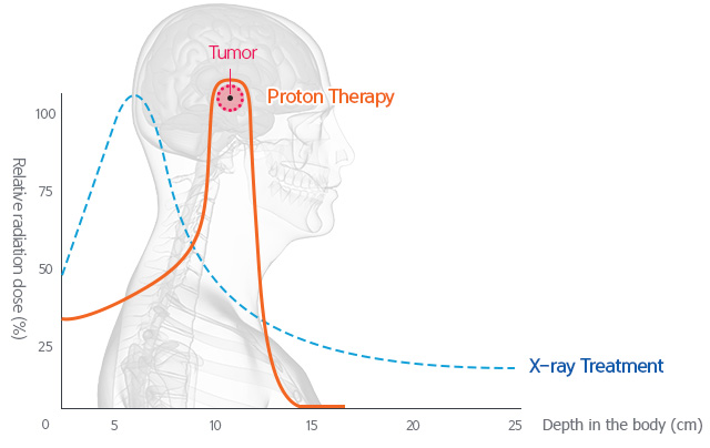 What is proton therapy for prostate