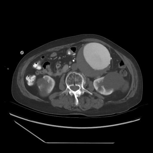 (AAA) diagnosis CT.jpg