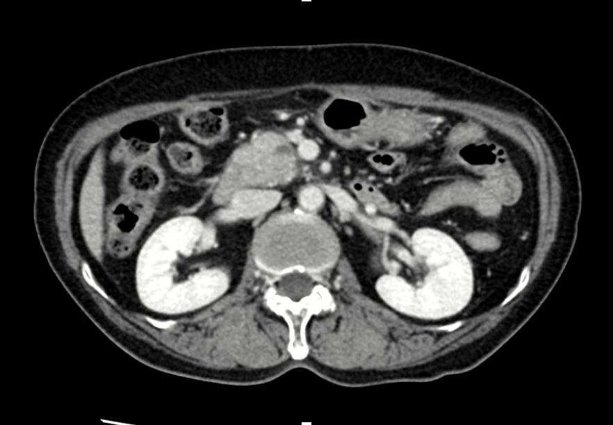 Pancreatic cancer(1).png Pancreatic cancer(1).png
