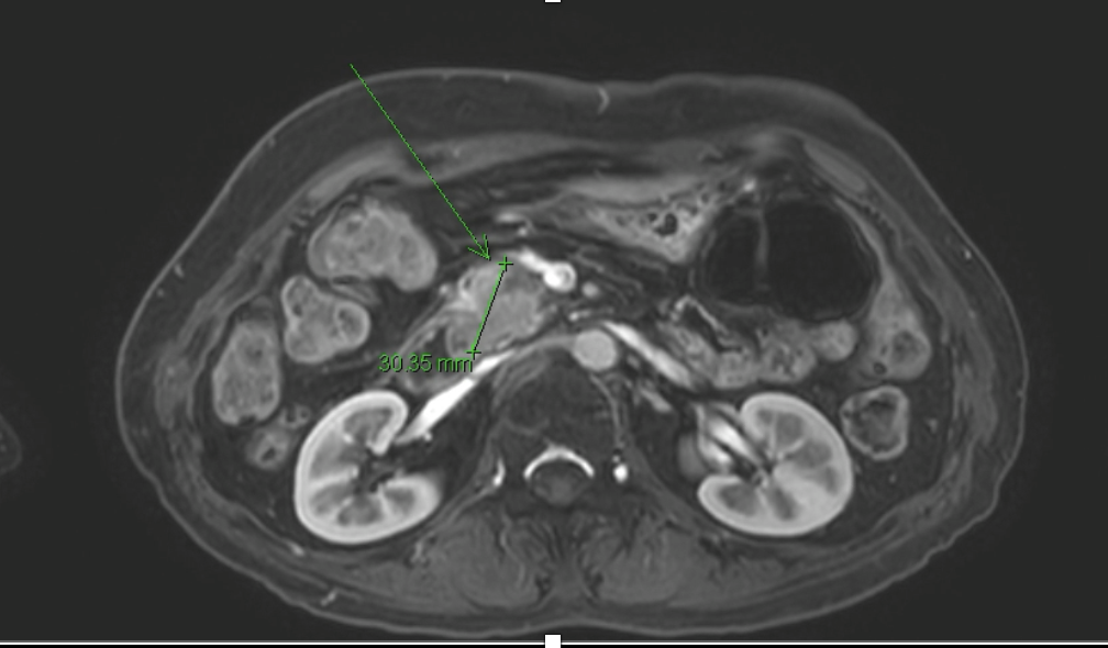 Pancreatic cancer(2).png Pancreatic cancer(2).png