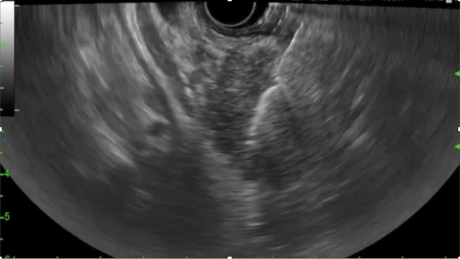 Pancreatic cancer(3).png Pancreatic cancer(3).png