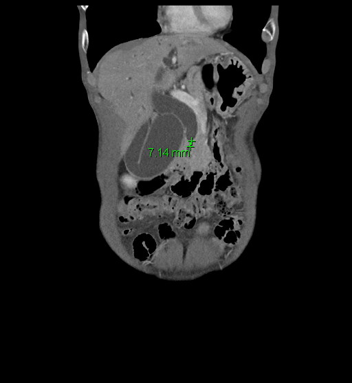 Bile duct cancer(2).jpg Bile duct cancer(2).jpg