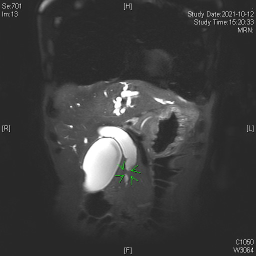 Bile duct cancer(3).jpg Bile duct cancer(3).jpg