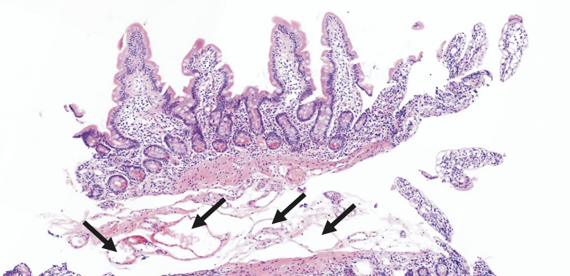 Intestinal lymphangiectasia (2).png Intestinal lymphangiectasia (2).png