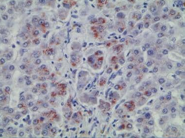 Wilson disease(2).png