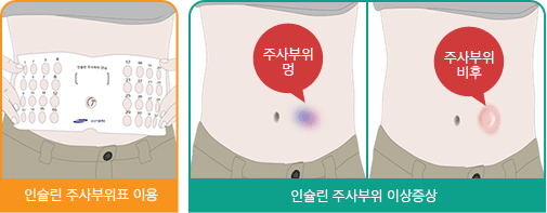 인슐린 주사부위표 이용, 인슐린 주사부위 이상증상(주사부위 붉어짐, 주사부위 비후)